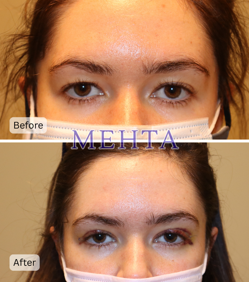 Before and after upper eyelid blepharoplasty comparison, labeled MEHTA