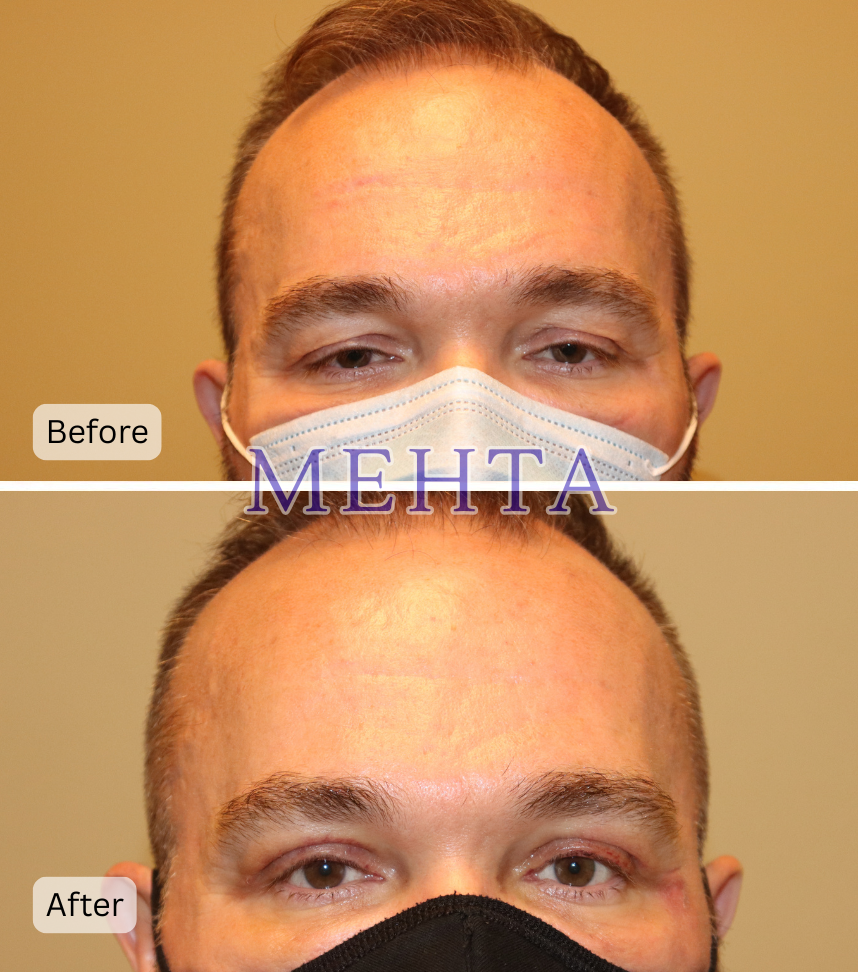 Before and after upper eyelid blepharoplasty with internal brow lift, showing reduced upper eyelid fullness