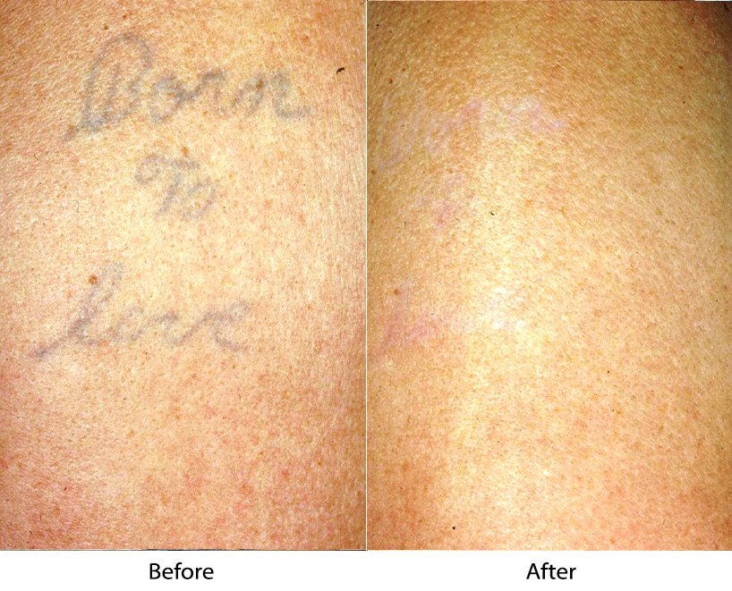 Chest tattoo before and after removal treatment showing significant fading
