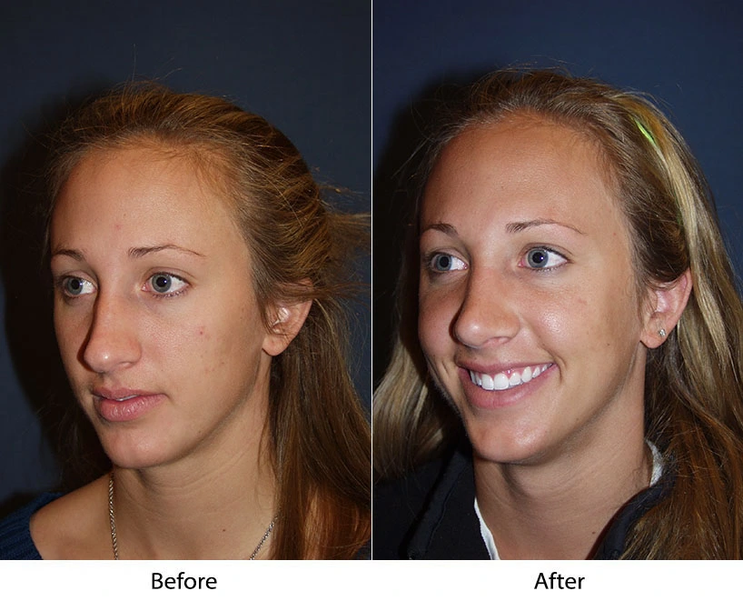 Before and after three-quarter view comparison showing improved facial balance and smile