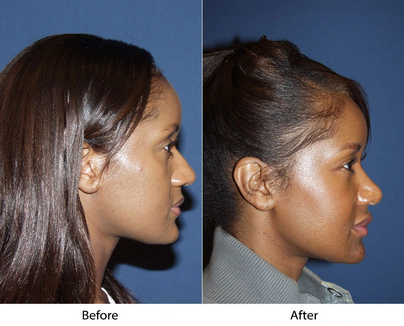 Before and after side profile comparison showing refined nose and improved facial harmony