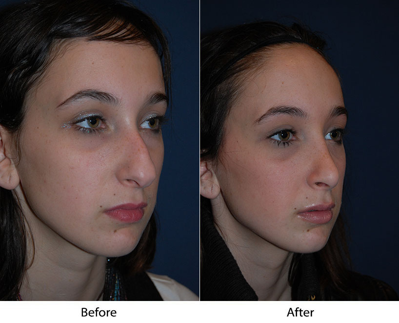 Young woman's face before and after facial procedure, three-quarter view against blue background