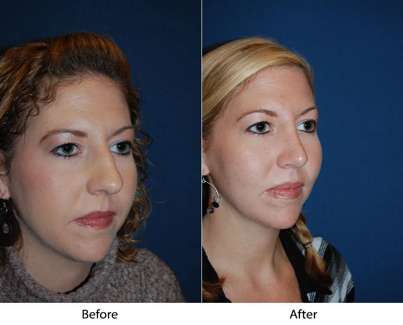 Before and after three-quarter view comparison showing patient's facial profile