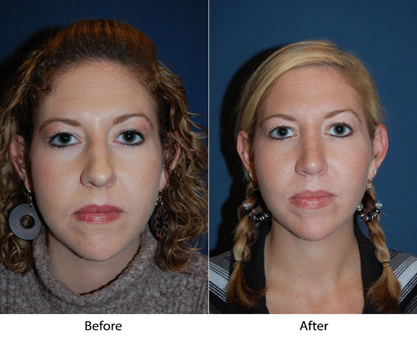 Before and after frontal facial comparison showing patient's face and shoulders