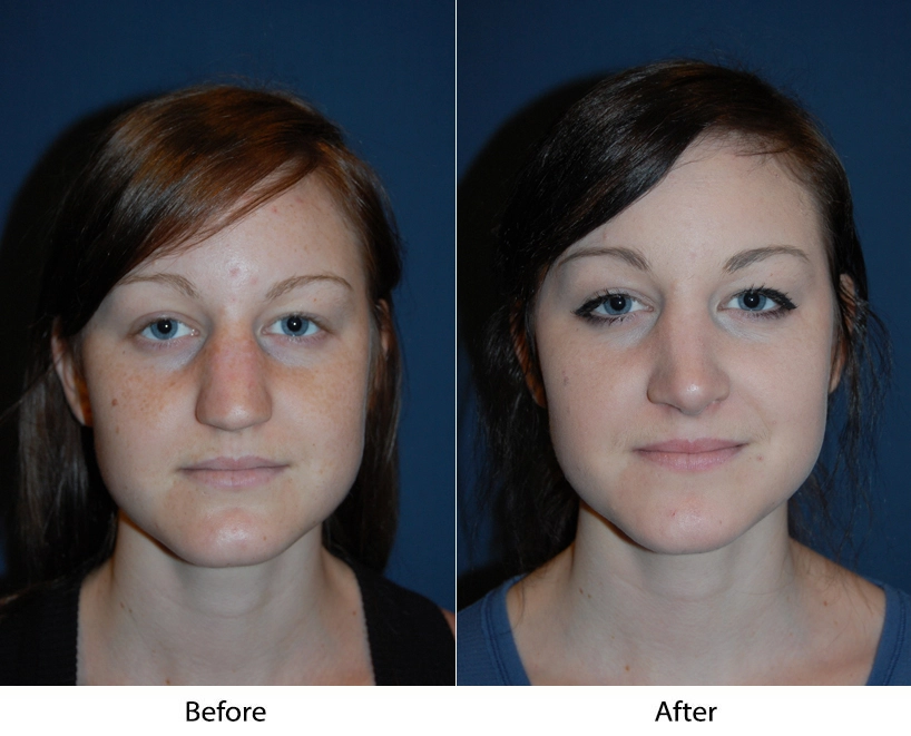 Woman's frontal face before and after facial treatment, showing reduced under-eye hollowing and improved cheek volume