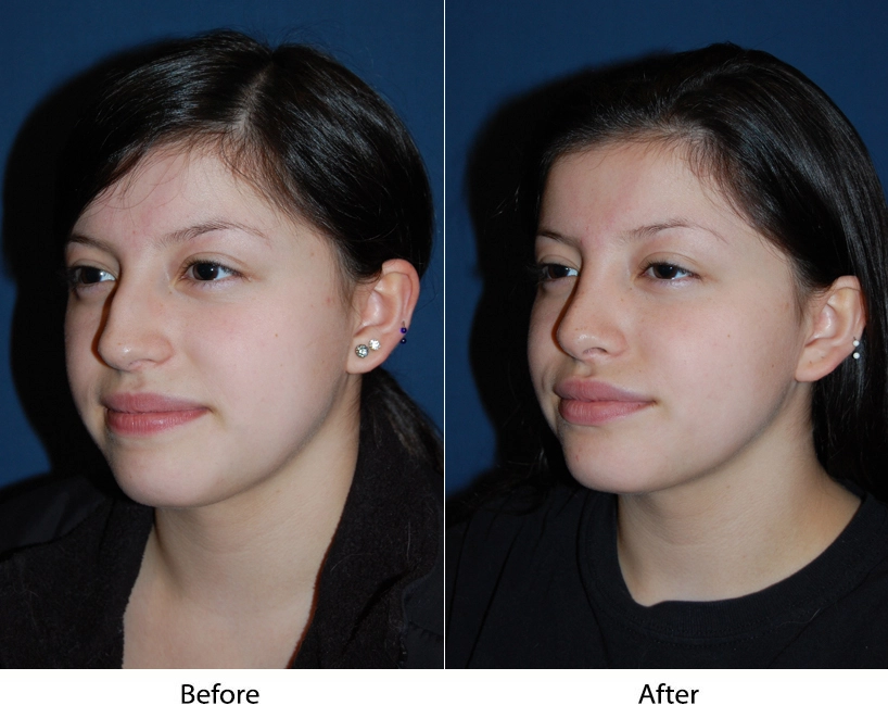Before and after three-quarter view comparison showing facial refinement results