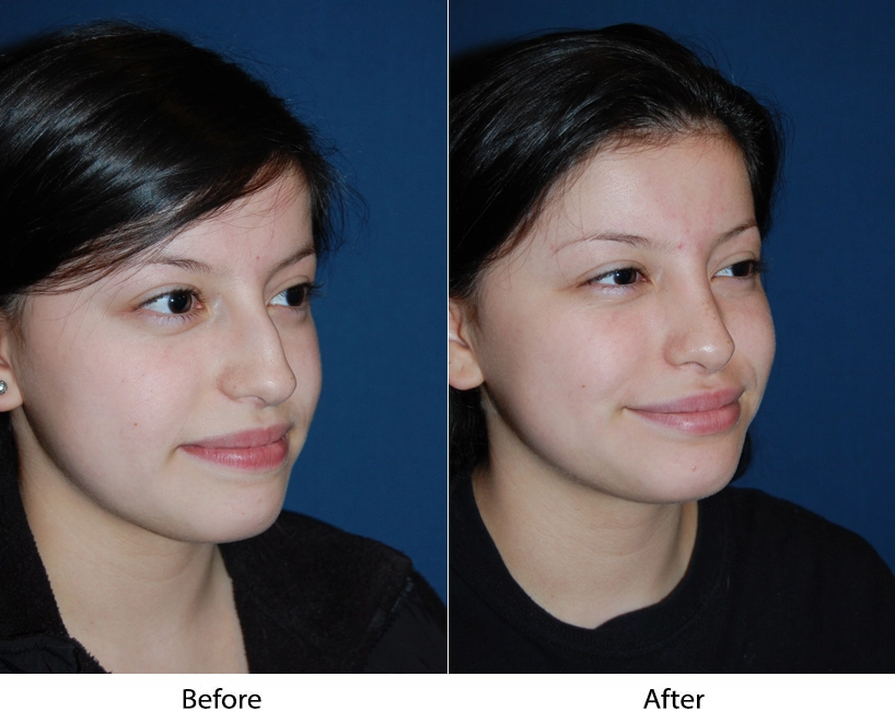 Before and after three-quarter view comparison showing facial enhancement results