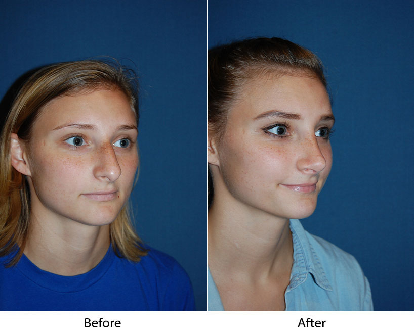 Young woman's three-quarter view before and after treatment showing refined facial structure