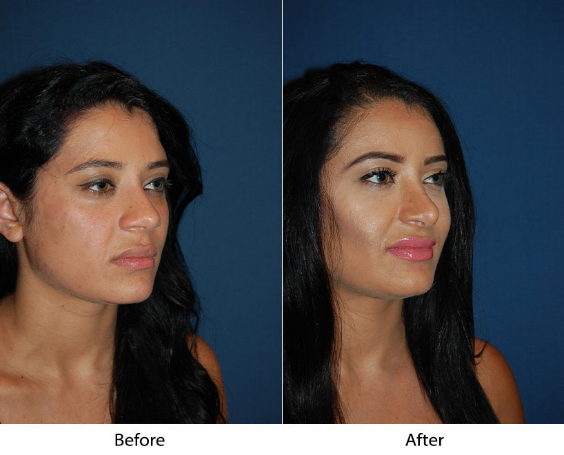 Before and after profile and three-quarter views showing facial contouring results