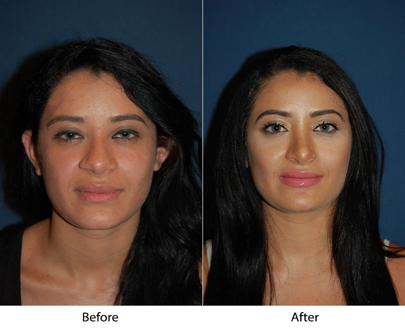 Woman's frontal view before and after facial treatment showing enhanced cheekbones and overall balance