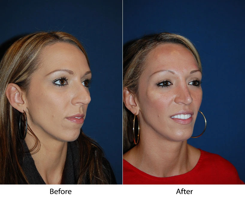Woman's face in profile before and after smile enhancement treatment, showing improved smile aesthetics