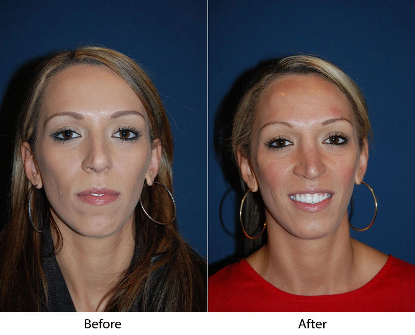 Woman's face in frontal view before and after smile enhancement treatment, displaying brighter smile