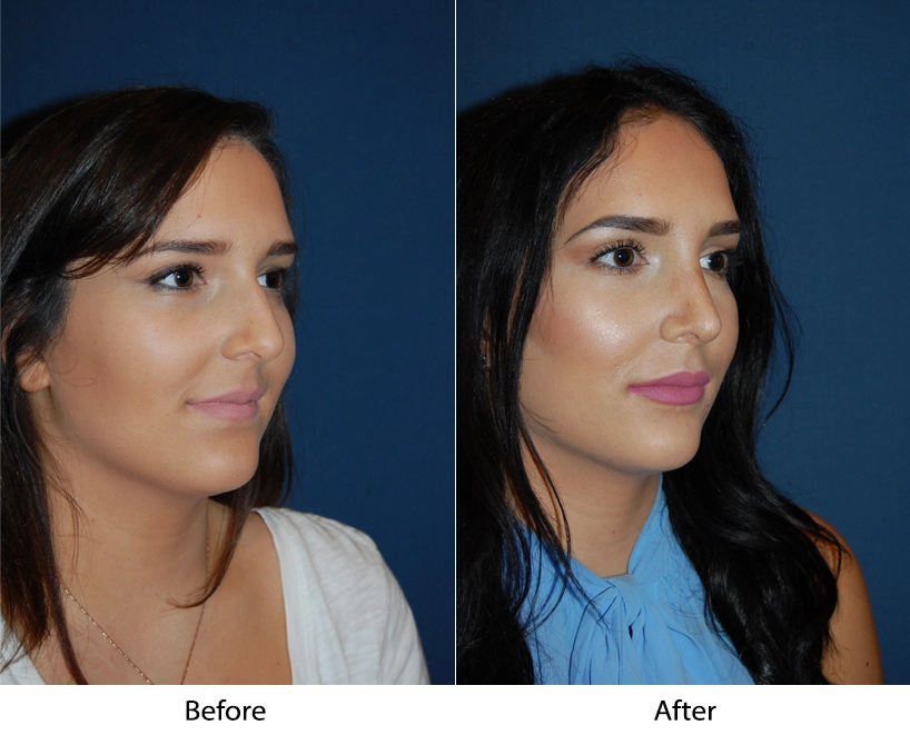 Woman's three-quarter profile before and after procedure, showing refined nose and chin structure