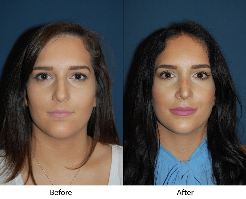 Woman's frontal face before and after procedure, showing refined nose and enhanced facial proportions