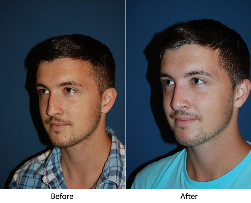 Before and after facial profile views of a male patient facing front and side