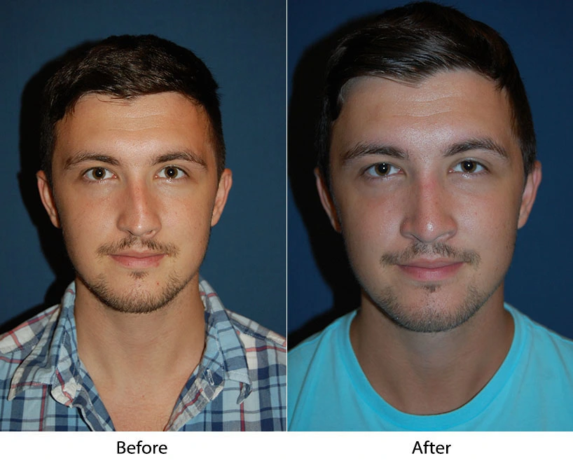 Man's front-facing view before and after facial procedure, showing refined facial proportions