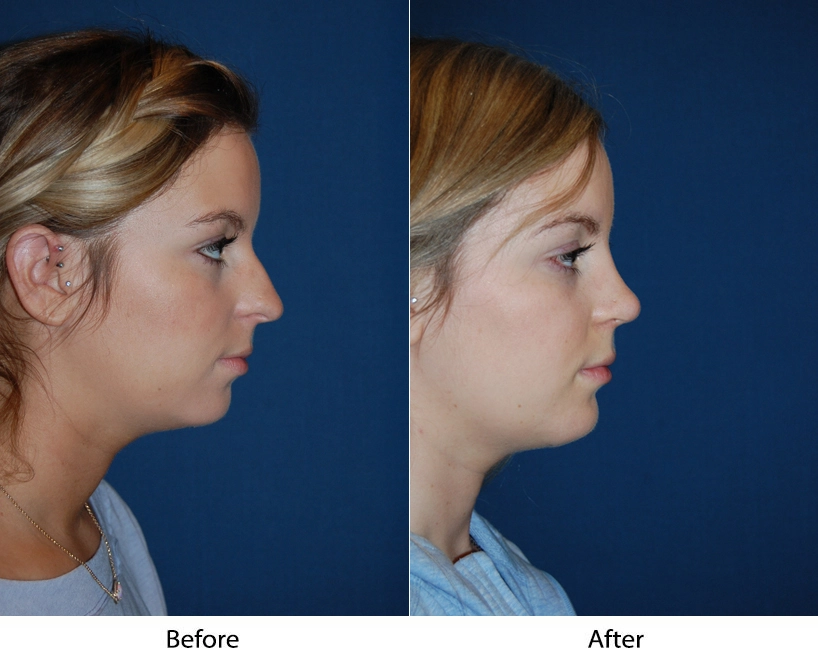 Before and after side profile views of a female patient facing right