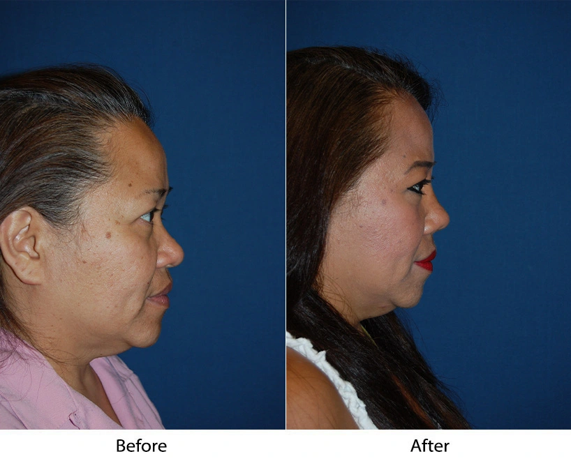 Before and after facial comparison, profile view: patient before treatment, refined facial structure after