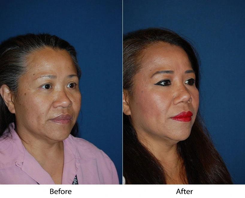 Before and after facial comparison, three-quarter view: patient before treatment, enhanced facial contours after