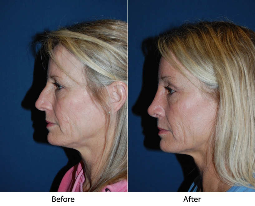Woman's face before and after cosmetic treatment, side profile view