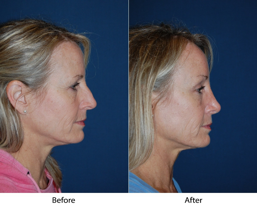 Woman's face before and after cosmetic treatment, side profile view