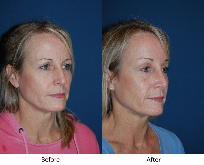 Woman's face before and after cosmetic treatment, three-quarter profile view