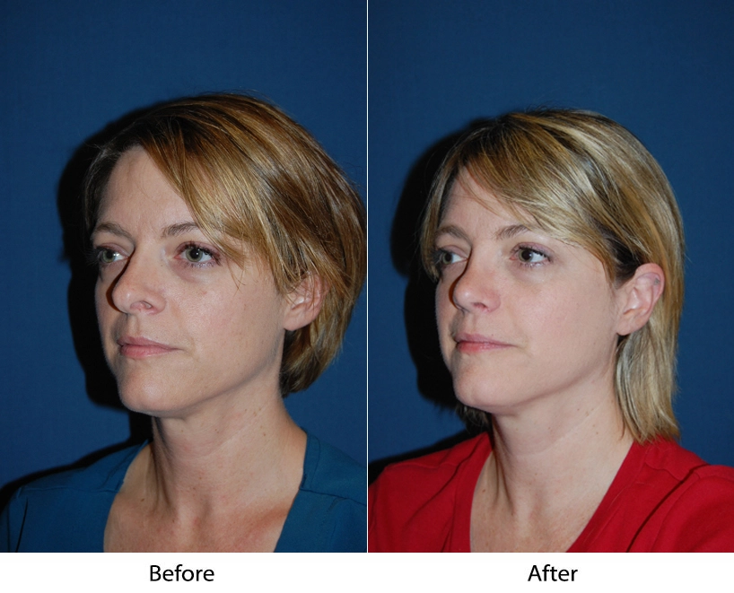 Before and after three-quarter views of a female patient showing facial shape refinement