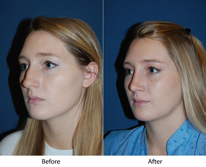 Before and after profile views of a patient showing facial changes from aesthetic treatment
