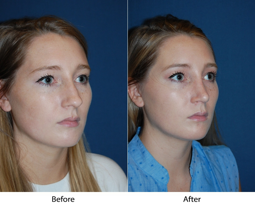 Before and after 3/4 views of a patient showing facial changes from aesthetic treatment