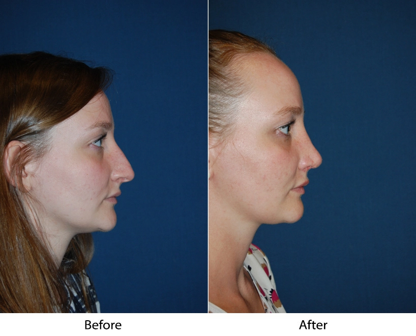 Before and after profile views of a patient showing facial profile enhancement