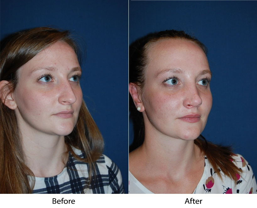 Before and after 3/4 views of a patient showing facial structure refinement