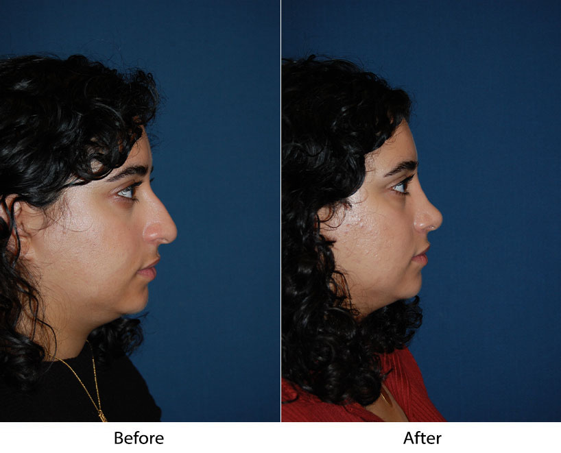 Before and after profile view comparison of person's face showing improved chin and jawline definition
