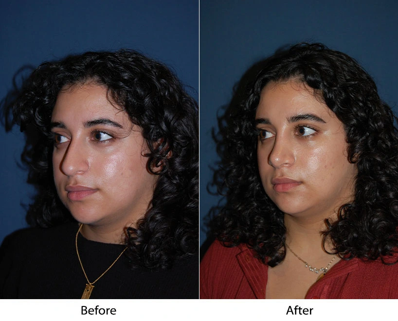 Before and after three-quarter view comparison of person's face showing enhanced facial structure
