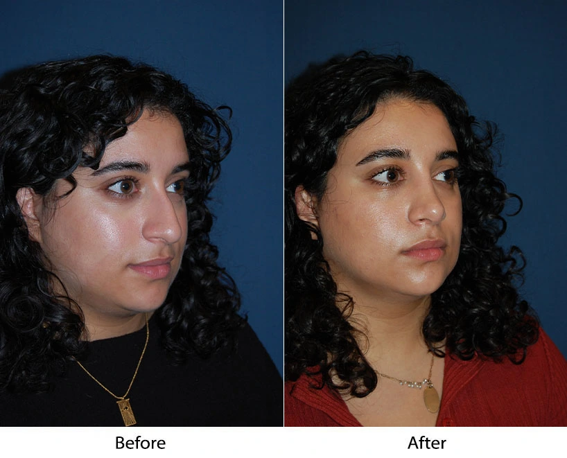 Before and after three-quarter view comparison of person's face showing refined facial proportions