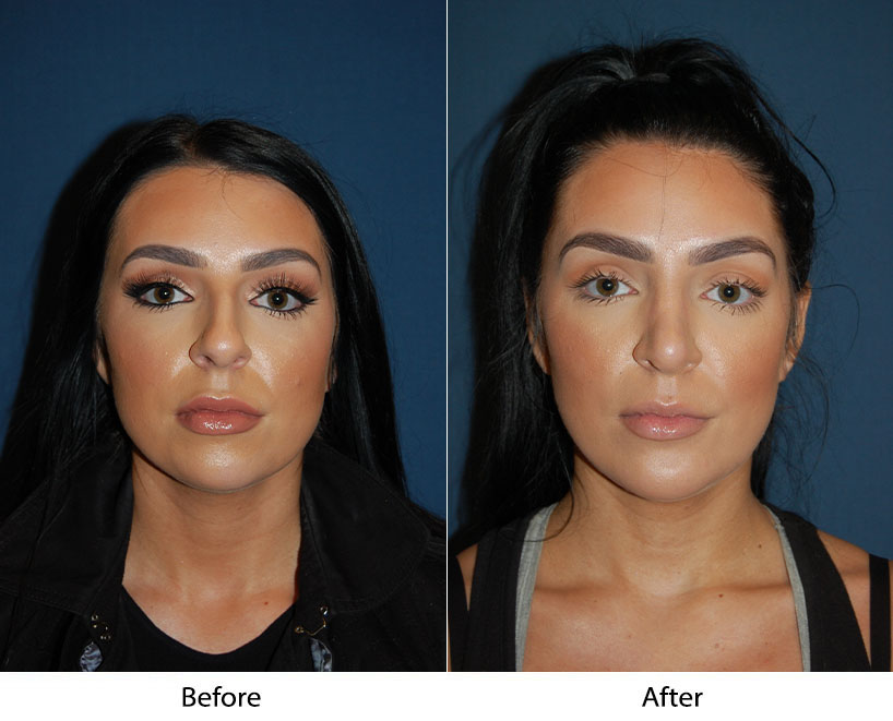 Before and after frontal views showing facial refinement results
