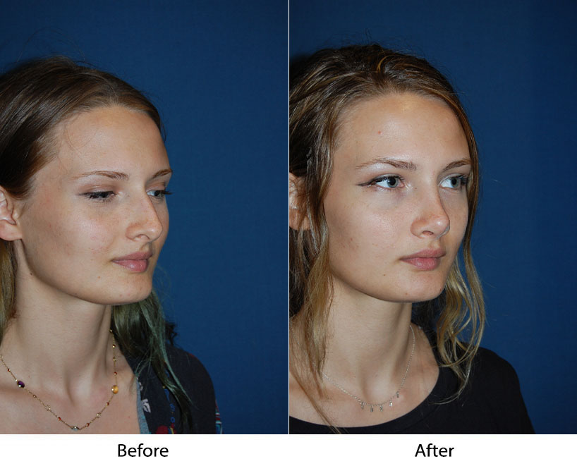 Before and after three-quarter facial views showing facial structure refinement
