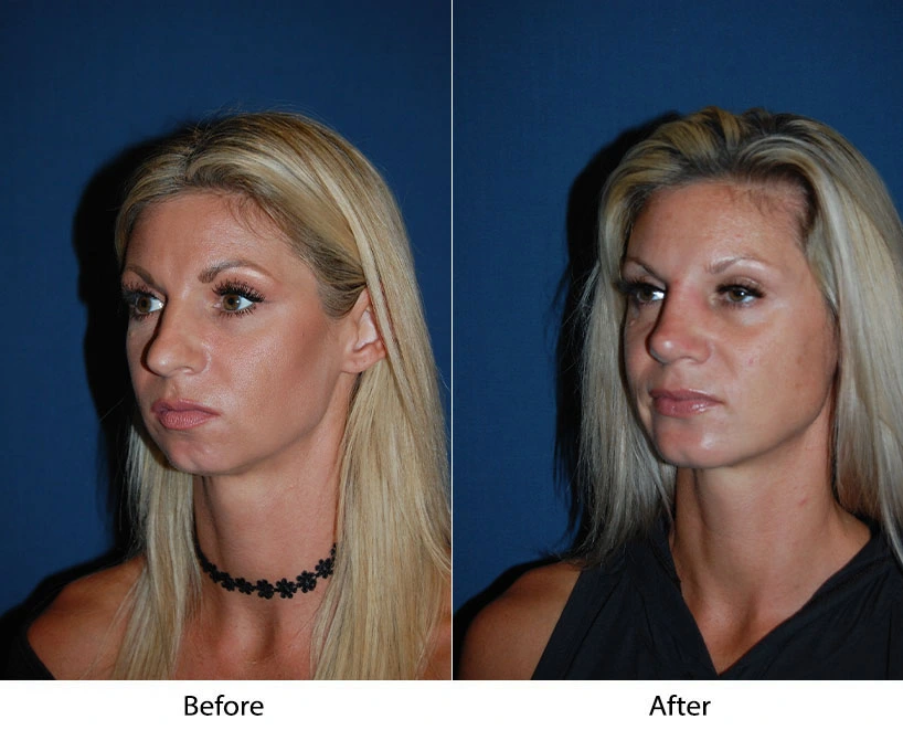 Before and after three-quarter view of female patient showing facial contouring results