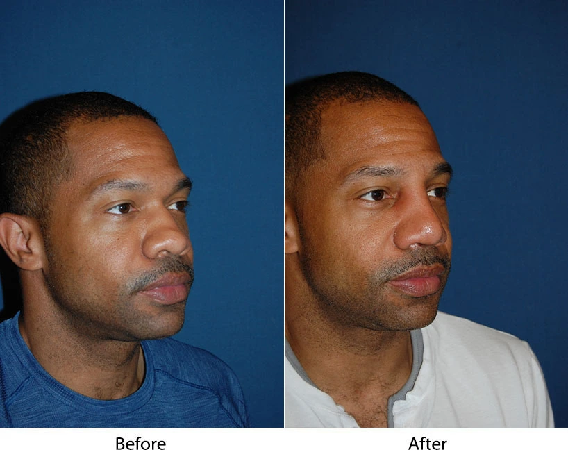 Before and after profile views of man's face showing facial definition changes