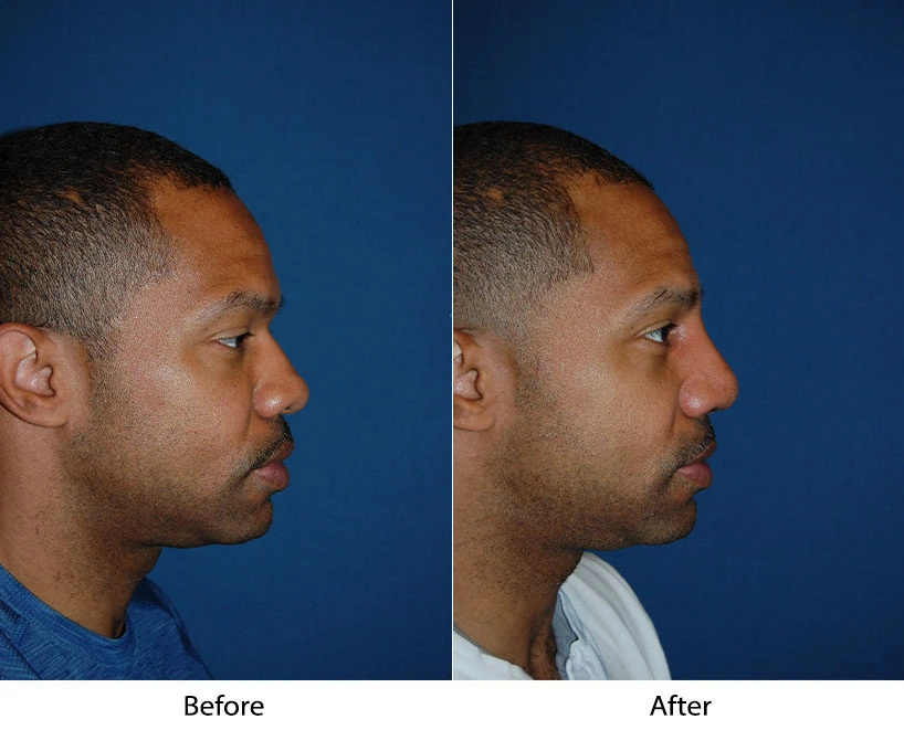 Before and after side profile of male patient showing chin enhancement results