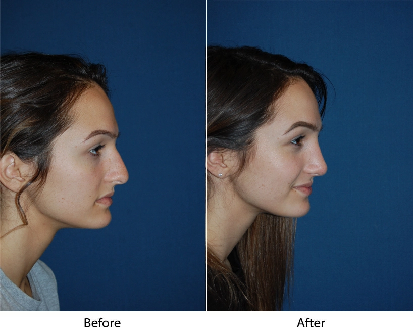 Woman's profile before and after showing refined chin and jawline contour
