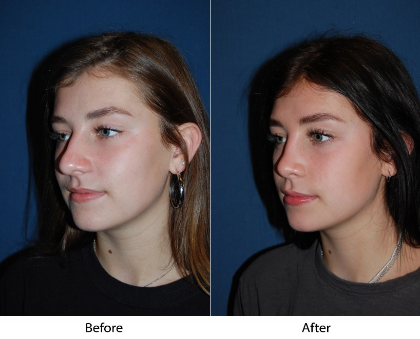 Before and after profile views showing refined nasal profile and chin projection