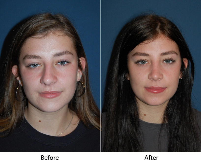 Before and after front views showing refined nose shape and improved facial symmetry
