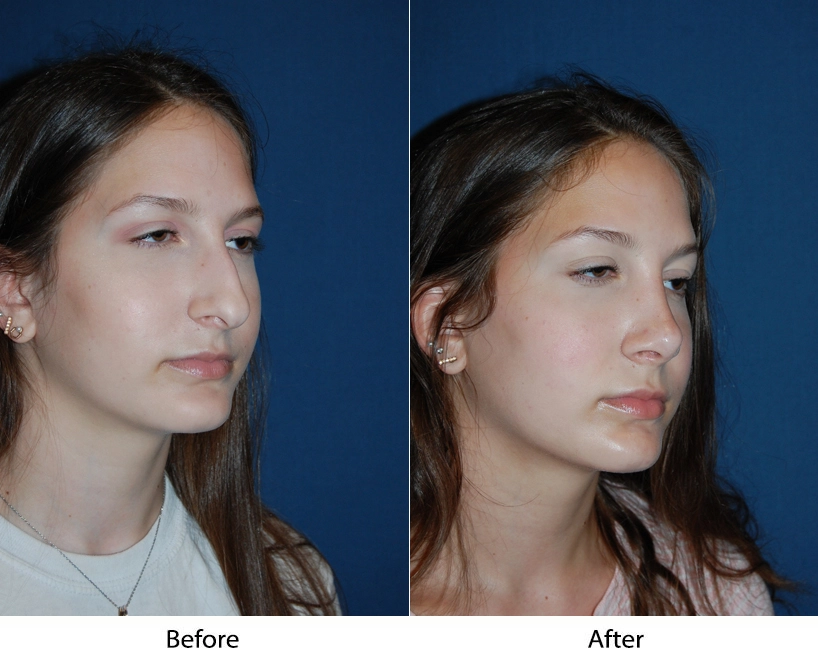 Before and after profile views showing enhanced facial contours and jawline definition
