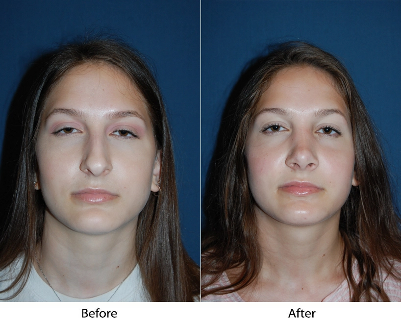 Before and after frontal facial views showing improved facial definition and skin texture