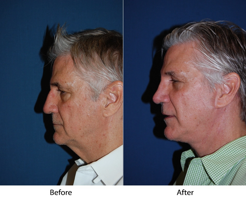 Male patient profile comparison: before shows relaxed jawline, after shows more defined jaw structure