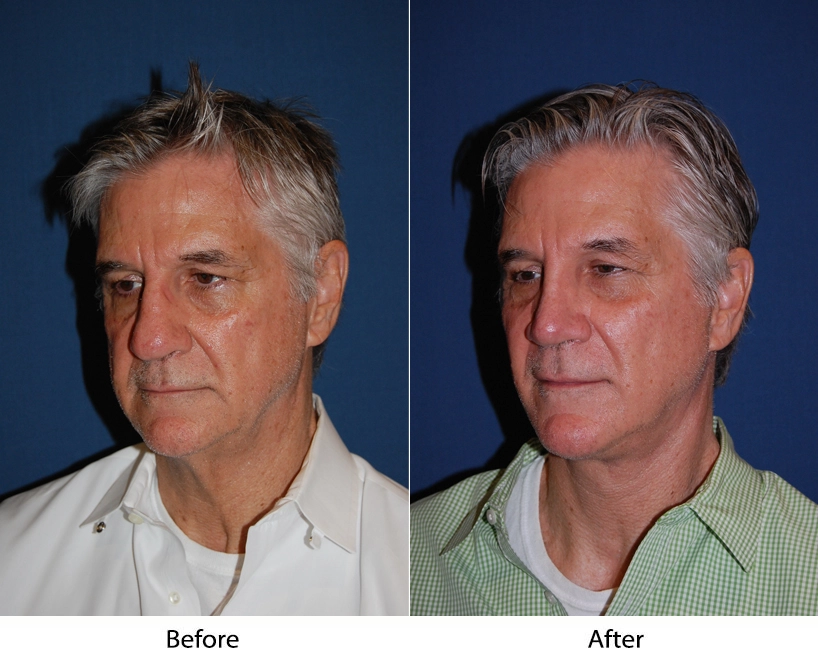 Before and after three-quarter views of male patient showing enhanced facial definition