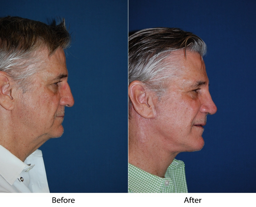 Before and after profile views of male patient showing refined jawline and chin definition