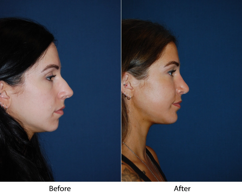 Woman's profile before and after facial procedure, showing nose and chin definition changes