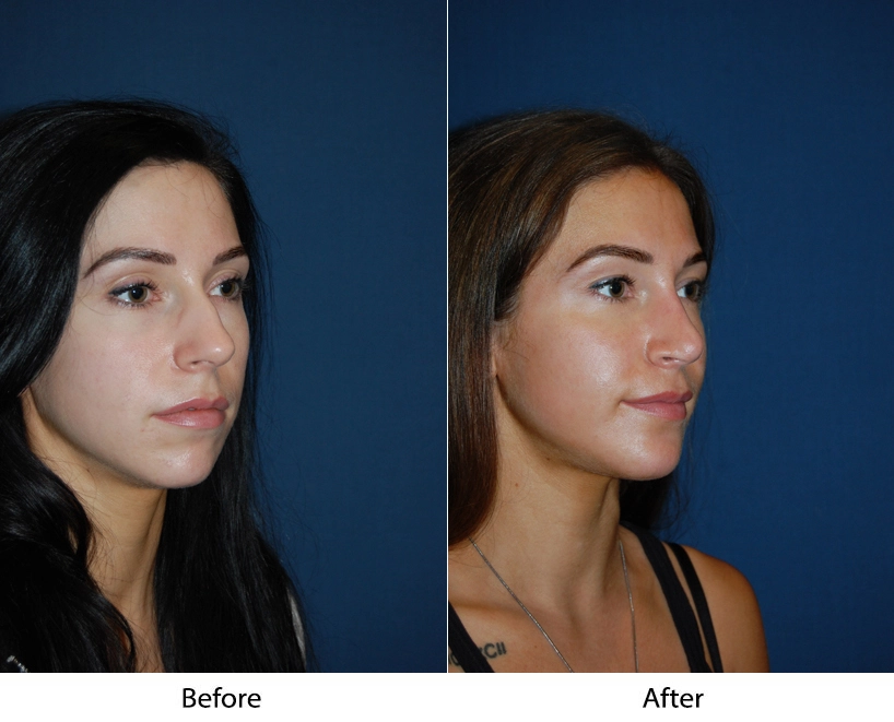 Woman's profile before and after facial procedure, showing side-by-side comparison