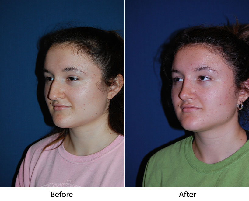 Before and after three-quarter view comparison of patient's face showing facial contouring results